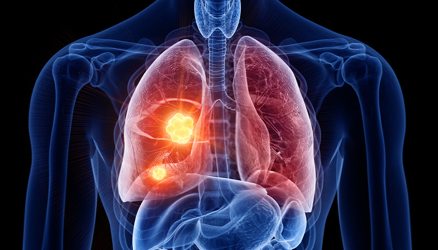 Lung-Disease-Compensation-Inflamed-Lung-Lawpoint